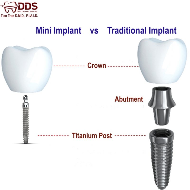 Traditional vs. Same Day Implants